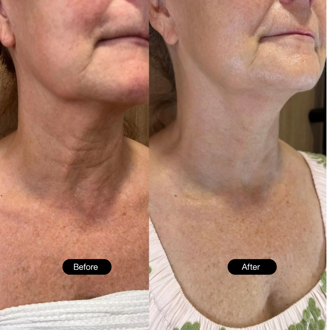 Nederm | Neck Firming Stick
